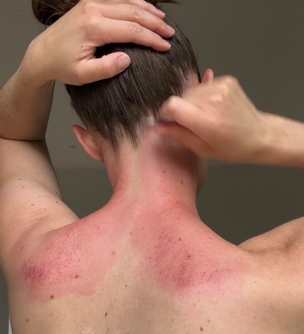 Gua sha massage på nakken og skuldrene, hvor sha er tydeligt